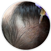 Hair Loss