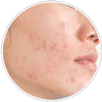 Acne & Acne Scar